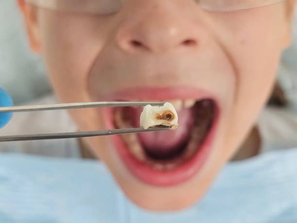 Best Emergency Dental Care for Sports Injuries in Browns Lake, WI